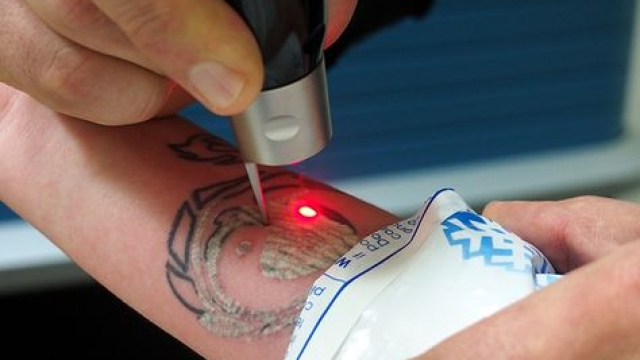 Four Facts You Absolutely Should Anticipate Before You Undertake Tattoo Laser Removal