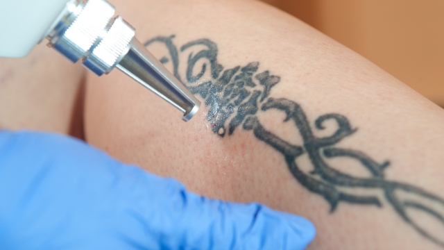 Frequently Asked Questions About Laser Tattoo Removal Procedures