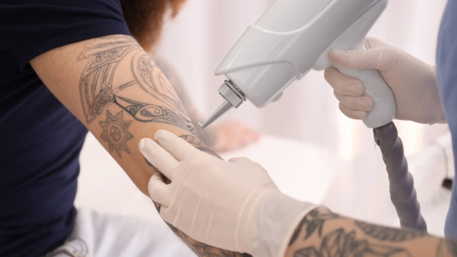 How To Accomplish Tattoos Removed Painlessly