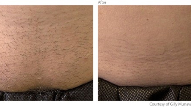 Laser Hair Removal: Unveiling a Smooth and Effortless You