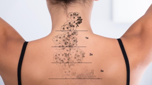 Tattoo Removal Methods – What Works And What Doesn’t